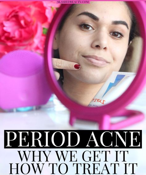 Find out why we get period acne-- why stubborn pimples appear and how to treat them -- I'm using ZAPZYT! | Slashed Beauty Period Acne, Get Rid Of Pimples Overnight, Rid Of Pimples Overnight, Get Rid Of Pimples, Rid Of Pimples, Pimples Overnight, Prevent Pimples, Ginger Benefits, Turmeric Health Benefits