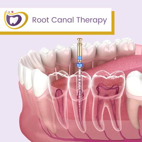 Root canal therapy is needed when the nerve of a tooth is affected by decay or infection. In order to save the tooth, the pulp (the living tissue inside the tooth), nerves, bacteria, and any decay are all removed, with the resulting space getting filled with special, medicated dental materials, which restore the tooth to its full function! If your tooth can be saved, why not go for it? Visit our website at https://www.cdsmile.com/ or give us a call at (707) 741-6090 today! . . . . #dentistry #de Filling Teeth, Toddler Tooth Decay, Dental Materials, Tooth Filling, Implant Dentist, Teeth Implants, The Nerve, Tooth Sensitivity, Dental Procedures