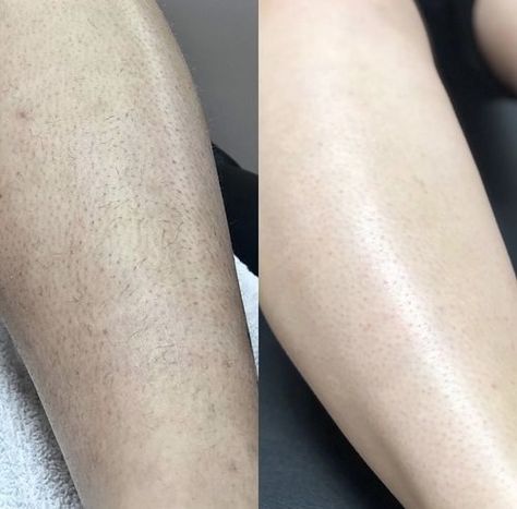 "One picture says more than 1000 words 🤩 happy with this purchase!" - Laurii P. Waxing Pictures, Cold Hair, Reduce Hair Growth, Waxing Tips, Upper Lip Hair, Beauty Skin Quotes, Diode Laser Hair Removal, Underarm Hair Removal, Laser Hair Removal Device