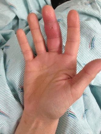 Finger Infection, Normal Vital Signs, Cardinal Signs, Hand Therapy, Medical History, Signs