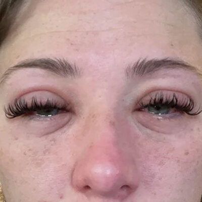 🌸 The Reasons Why You Suddenly Get Lash Extension Allergy and How to Combat It
🚨 Sudden allergy to lash extensions? It can happen even if you’ve had them before! Often caused by sensitivity to cyanoacrylate in the glue. 😟 Combat it by using hypoallergenic adhesives, and always do a patch test first! 🧴
————————————————————
𝐂𝐡𝐚𝐫𝐦𝐋𝐚𝐬𝐡® - 𝐓𝐨𝐩 𝐆𝐥𝐨𝐛𝐚𝐥 𝐰𝐡𝐨𝐥𝐞𝐬𝐚𝐥𝐞 𝐞𝐲𝐞𝐥𝐚𝐬𝐡 𝐞𝐱𝐭𝐞𝐧𝐬𝐢𝐨𝐧 𝐦𝐚𝐧𝐮𝐟𝐚𝐜𝐭𝐮𝐫𝐞𝐫 𝐢𝐧 𝐕𝐢𝐞𝐭𝐧𝐚𝐦
👉 Our official account @charmlashvn
👉 WhatsApp: +84 944 185 000
👉 Email: info@charmlash.com Lash Extension Glue, Allergy Remedies, Itchy Eyes, Clear Glue, Lash Adhesive, Allergy Symptoms, Beautiful Lashes, Lash Extension, Official Account