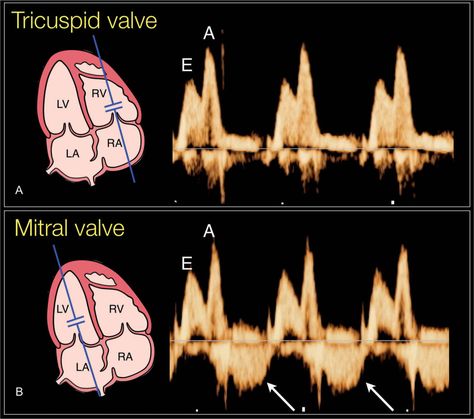 Fetal Echo Ultrasound, Dms Student, Echo Ultrasound, Fetal Echocardiography, Cardiovascular Sonography, Cardiac Ultrasound, Fetal Ultrasound, Obstetric Ultrasound, Cardiac Sonography