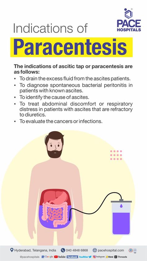 Paracentesis  indications New Grad Nurse, Abdominal Discomfort, Best Hospitals, Nursing Notes, Cavities, Hyderabad, Twitter Instagram, Drain, Tap