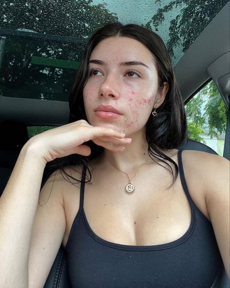 Girl With Acne Aesthetic, Girl With Acne, For Skin Care, Bare Face, Bare Beauty, Skin Care Shopping, Love Your Skin, Pretty Skin, Brunette Girl