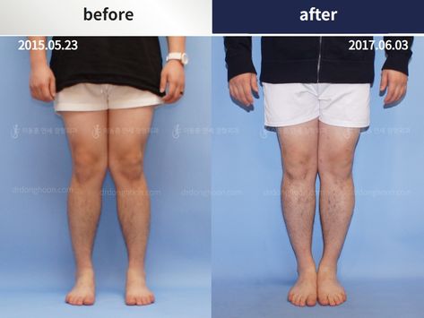 Case of leg deformity (knock knee) correction. Knock knee is not only cosmetically bad, but also has a detrimental impact on the general function (athletic abilities) Correcting knock knee is an urgent thing!!! Knock Knees Correction, Swollen Knee, Knock Knees, Knee Pain, Knock Knock, Surgery, Healing, Social Media, Quick Saves