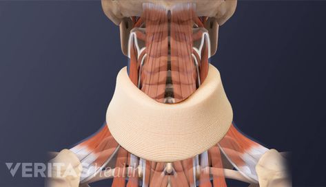 Potential Risks and Complications of ACDF Surgery | Spine-health Acdf Surgery, Spine Anatomy, Spinal Fusion Surgery, Cervical Disc, Vertebral Artery, Spine Care, Cervical Spondylosis, Spinal Fusion, Neck Surgery