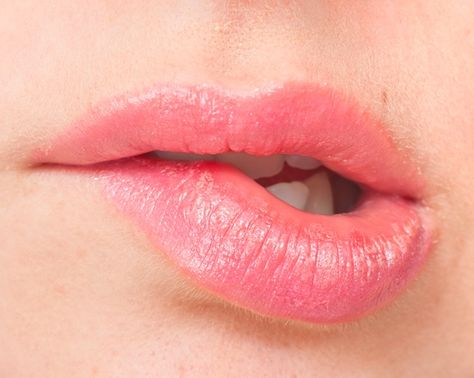 The Best Way to Soothe Sunburned Lips  #beauty #tips #skin #hair #body #care #women Sunburnt Lips, Blister Remedies, Sunburned Lips, Blister On Lip, Home Remedies For Sunburn, How To Treat Sunburn, Sunburn Remedies, Upper Lip Hair, Soothe Sunburn