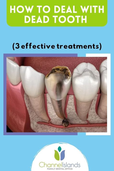 #dental #dentalhygiene #dentallife #dentalcare #dentalhygienist #dentalimplant #dentalclinic #dentalimplants #dentalsmile Dental Fillings, Family Dental, Channel Islands, Oral Health, Nerve, The Dead, Health