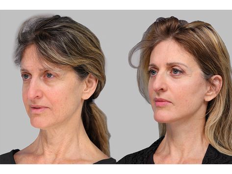 Everything to Know About the Newest Jawline-Tightening Treatments - NewBeauty Hyaluronic Acid Fillers, Fat Grafting, Facial Massage Tool, Subcutaneous Tissue, Neck Lift, Cool Sculpting, Facial Plastic, Healthy Hair Journey, Nothing New