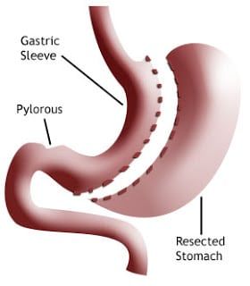 Foodie-sentials: What Vitamins Should VSG patients take? Bariatric Vitamins, Vertical Sleeve Gastrectomy, Bariatric Sleeve, Gastric Band, Bariatric Surgeon, Sleeve Gastrectomy, Sleeve Surgery, Flat Tummy, Plastic Surgery