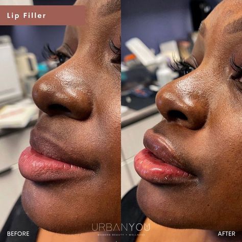 Lip Filler | Before and After Lip Fillers On Black Women, Aesthetic Procedures, Lip Flip, Face Fillers, Lip Filler, Keto Lifestyle, Lip Fillers, Self Acceptance, Mental Clarity