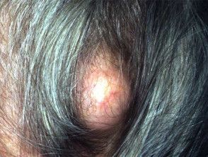 Pilar cyst. Trichilemmal cyst | DermNet Bump On Head, Infected Hair Follicle, Symptoms Of Concussion, Severe Headache, Skin Disorders, Things Under A Microscope, Roots Hair, Ingrown Hair, Hair Follicle