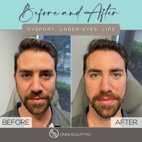 Before and after photo of a male with tear trough filler, lip filler and Dysport injections for anti-aging. Performed by Dr. Louis DeGironemo at OMNI SCULPT Medspa in Dallas, TX Mens Facial, Facial Fillers, Facial Contouring, Injectables Fillers, Nasolabial Folds, Just For Men, Dermal Fillers, Aging Process, Don't Be Afraid