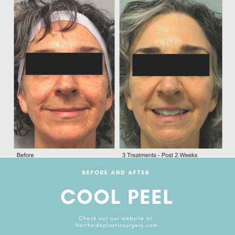 CoolPeel is a quick and amazing procedure done in the office for individuals who are looking to not only brighten their complexion but also reduce and smooth fine lines! It takes less than 20 minutes from start to finish and leaves you feeling radiant! ⭐️ Call to schedule your FREE virtual consultation to discuss further at 770-475-3146❤️  . . #coolpeel #skin #cartessa #stayforeveryoung #laser #resurfacing #nodowntime #cosmeticsurgeon Virtual Consultation, Laser Resurfacing, The Office, Mens Sunglasses, How Are You Feeling, Take That, Sunglasses, Skin