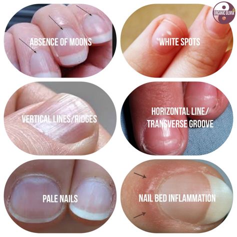 What Your Fingernails are Trying to Tell You About Your Health | Organic Olivia Fingernail Health, Pale Nails, Calendula Benefits, Matcha Benefits, Lemon Benefits, Coconut Health Benefits, February Nails, Stomach Ulcers, Benefits Of Coconut Oil