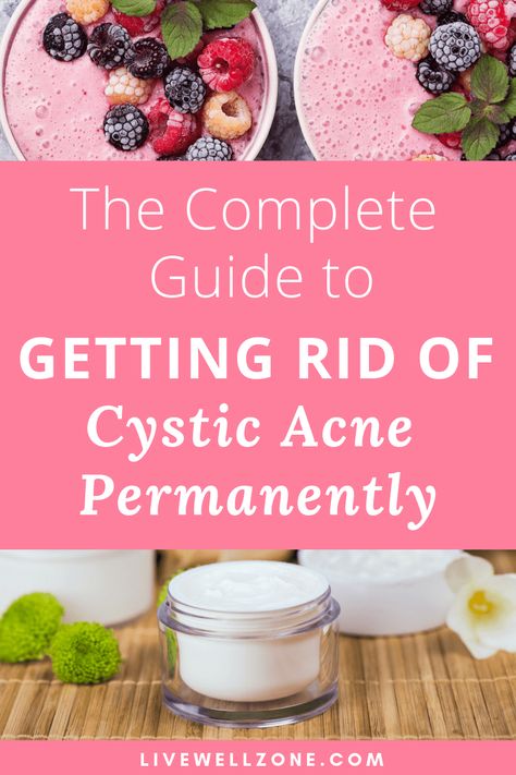 Cystic Acne Diet Plan, Acne Diet Plan Hormonal, Acne Meal Plan, Get Rid Of Cystic Acne, Acne Diet Plan, Nodule Acne, Acne Journey, Treating Cystic Acne, Cystic Acne Remedies