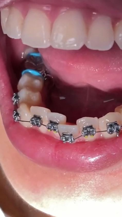 Amazing braces transformation! [Video] | Getting braces, Braces transformation, Braces tips Braces Transformation, Dental Wallpaper, Braces Tips, Getting Braces, Braces Off, Men Skin Care Routine, Orthodontic Appliances, Dental Videos, Braces Colors