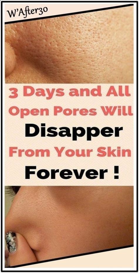 3 Days and All Open Pores Will Disappear From Your Skin Permanently Apple Cider Vinegar For Skin, Cardiac Diet, Organic Aloe Vera Gel, Open Pores, Baking Soda Shampoo, Skin Pores, Enlarged Pores, Minimize Pores, Skin Toner