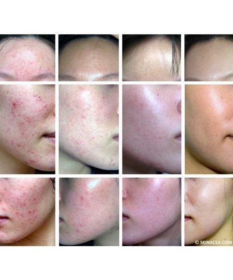 I Spent Thousands Battling Hormonal Acne, and a $20 Regimen Cured It | Through a four-year trial-and-error method, I finally found what keeps my acne under control. Post Acne Marks, Natural Acne, Severe Acne, Hormonal Acne, Beauty Remedies, Acne Remedies, Skin Remedies, How To Get Rid Of Acne, Acne Marks