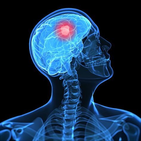 Learn about Glioblastoma, also known as glioblastoma multiforme or a grade 4 astrocytoma, one of the most common and aggressive types of brain tumors. Tuberous Sclerosis, Glial Cells, Brain Tumour, Pet Ct, Genetic Diseases, Memory Problems, Medical Anatomy, Nerve Cell, Rare Disease