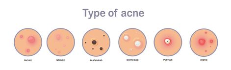 Acne concept. type of acne.papule,nodule,blackhead'whitehead,pustule,cystic.flat vector illustration. Acne Drawing, Heads Drawing, Black Heads, Types Of Acne, Pinterest Diy Crafts, Flat Vector Illustration, Pinterest Diy, Flat Vector, Blackheads