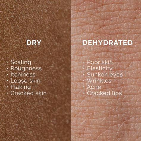 Do you have dry or dehydrated skin? Comment below 👇🏼 #dryvsdehydrated #marycohr #dryskin #dehydratedskin Dry And Dehydrated Skin, Dehydrated Face, Cosmetic Science, Facial For Dry Skin, Eyelash Business, Sunken Eyes, Cracked Lips, Cracked Skin, Wrinkled Skin