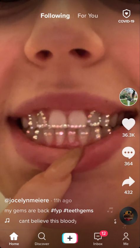 Teeth Gems Retainer, Gems On Invisalign, Tooth Gems Front Teeth, Retainers With Gems, Bedazzled Retainer, Basic Tooth Gem Ideas, Tooth Gems Design, Gems On Teeth, Tooth Gems Men