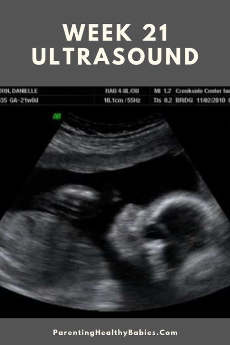 #week21ultrasound #ultrasoundat21weeks #ultrasound 21 Weeks Pregnant Ultrasound, Pregnant Ultrasound, 21 Weeks Pregnant, Pregnancy Week, Pregnancy Belly, Weeks Pregnant, Pregnancy Symptoms, Pregnant Belly, Pregnancy Week By Week