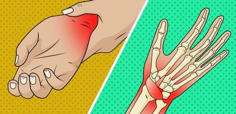 Ever have your hand just go limp at night? There's a major reason this could be happening. Here's how to prevent it. Carpal Tunnel Remedies, Arm Numbness, Carpal Tunnel Exercises, Numbness In Hands, Median Nerve, Feeling Numb, Natural Health Care, Healthy Lifestyle Habits, Carpal Tunnel