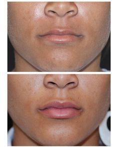 Voluma Cheeks, Juvederm Before And After, Lip Fillers Juvederm, Juvederm Lips, Botox Before And After, Face Fillers, Botox Lips, Botox Cosmetic, Cheek Fillers