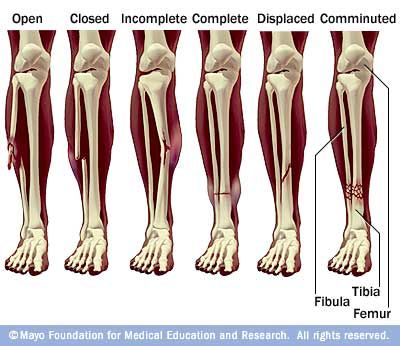 Fractures Nursing, Surgical Technologist, Bone Fracture, Radiology Technologist, Orthopedic Surgery, Medical Imaging, Medical Coding, Nursing Tips, Nursing Study