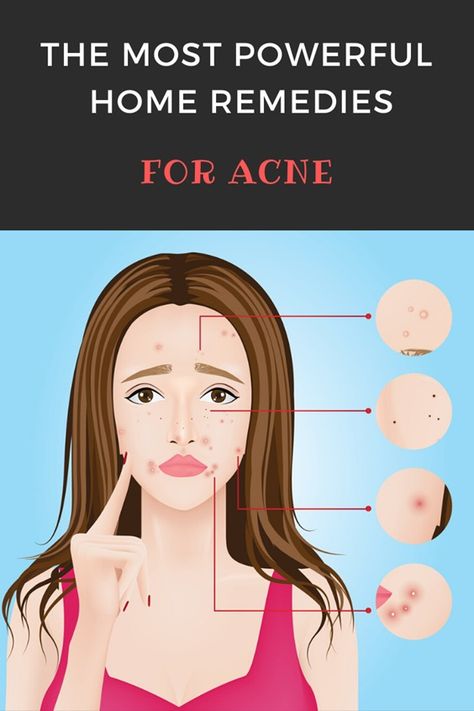 Different Types Of Acne, Remedies For Acne, Growing Healthy Hair, Bad Acne, Ways To Be Healthier, Pimples Remedies, Natural Acne Remedies, Home Remedies For Acne, Blemish Remover