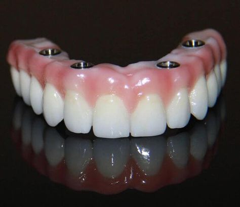 Denture Implants, Dental Posters, Dental Implant Surgery, Dental Implants Cost, Laser Teeth Whitening, Dental Facts, Implant Dentistry, Teeth Implants, Dental Bridge