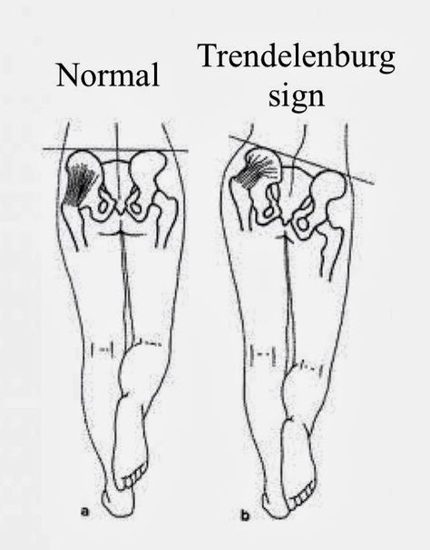 Lumbar Spinal Stenosis - Physiopedia Pelvic Tilt, Gluteus Medius, Tight Hip Flexors, Back Pain Remedies, Psoas Muscle, Hip Pain, Hip Flexor, Low Back Pain, Massage Therapy