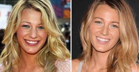 Which celebrities are most likely to have had nose jobs? The subject is a hotly debated one. Some celebs come clean and admit that they've had work done, including ... Blake Lively Nose, Nose Plastic Surgery, Nose Jobs, Nose Reshaping, Celebrity Smiles, Nose Contouring, Celebrities Before And After, Lip Injections, Black Celebrities