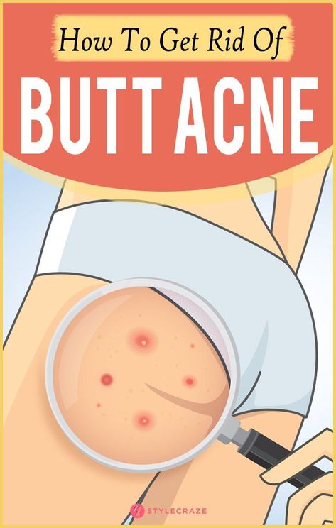 How To Get Rid Of Butt Acne Fast?? So, here we are to your rescue, yet again! We have listed some of the best home remedies that can help you combat butt acne – and also your worries! #homeremedies #skincare #skincaretips Forehead Acne, Natural Acne Remedies, Natural Acne, Body Acne, Acne Scar Removal, Acne Facial, Scar Removal, Acne Remedies, Skin Remedies