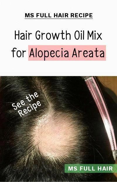 #HomeRemediesForHairLossInFemales #NaturalHairLossRemediesThatWork Hair Oils For Growth, Alopecia Hair Growth, Foods For Hair Growth, Essential Oil Hair, Foods For Hair, Hair Growth Home Remedies, Hair Fall Remedy, Essential Oil Hair Growth, Natural Hair Growth Remedies