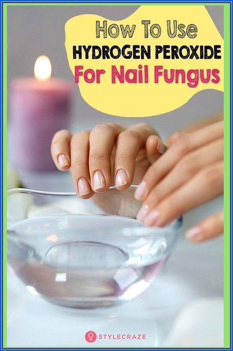 toe nail fungal infection home remedies Blind Pimple, Nail Fungus Remedy, Nail Infection, Fungal Nail, Health Signs, Toenail Fungus, Fungal Infection, Nail Fungus, Hydrogen Peroxide