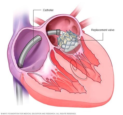 Mitral valve repair and mitral valve replacement - Care at Mayo Clinic - Mayo Clinic Mitral Valve Regurgitation, Prothrombin Time, Cardiac Sonography, Heart Valve, Nurse Teaching, Tricuspid Valve, Mitral Valve, Lung Transplant, Heart Valves