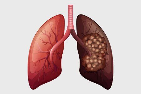 Hospital Health, Chronic Cough, Natural Cough Remedies, Types Of Cancers, Signs And Symptoms, Lungs, India