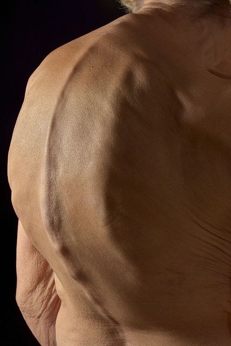 "The next long photograph from Mark Bartley, based at Addenbrookes Hospital in Cambridge, is of a 79-year-old woman's back, showing an abnormally curved spine. This hunched back appearance is known as kyphosis, or "dowager's hump", and causes the upper back and shoulders to round forward." Dowager's Hump, Glial Cells, Science Images, Scanning Electron Micrograph, Medical Photography, Too Much Estrogen, Brain Tissue, Weird Images, Science Photos