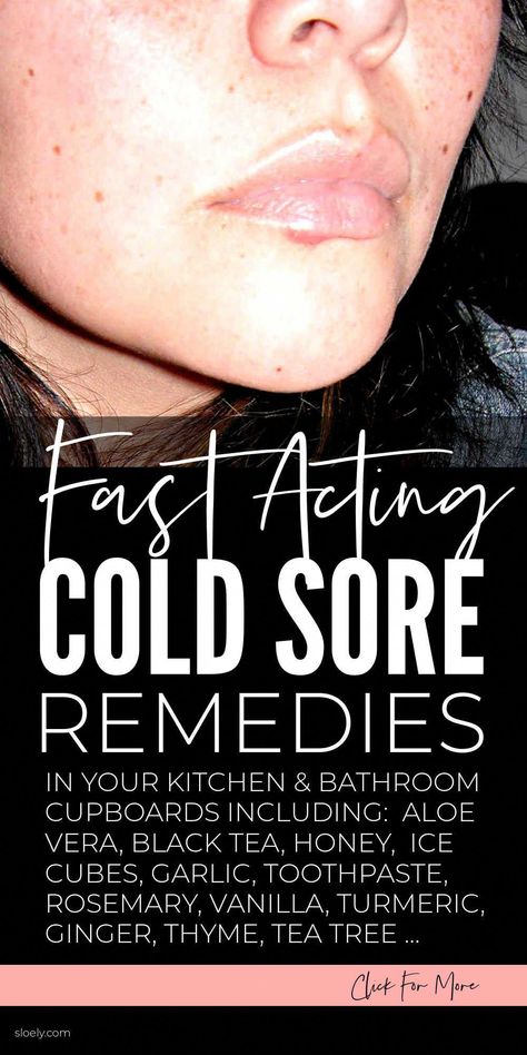 Cold Sore Remedy Fast, Cold Sore Remedy Overnight, Cold Sore Remedies, Natural Cold Sore Remedy, Cold Sore Prevention, Cold Sore Relief, Home Remedies For Allergies, Home Remedies For Warts, Get Rid Of Cold