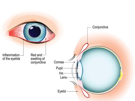 Common causes of red veins in eyes Red Veins In Eyes, Bloodshot Eyes, Red Veins, Human Eyes, Blood Sugar Diet, Pink Eye, Health Information, Todo List, Red Eye