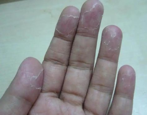 Skin peeling on fingers may be one of the most perplexing, let alone uncomfortable, strange skin symptoms you can experience. But, before you panic, know that it’s quite common — and, in the vast majority of cases, not cause for concern. However, there are some common causes, such as dry skin caused by a cold climate or frequent handwashing, as well as more chronic conditions such as eczema or psoriasis. Skin Peeling On Hands, Peeling Fingertips, Cracked Fingertips, Cracked Fingers, Dry Peeling Skin, Itchy Hands, Peroxide For Acne, Dry Scaly Skin, Dry Skin Causes