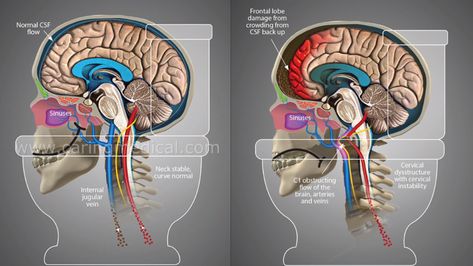 This article will concentrate on the aspects of Meniere’s Disease caused by upper cervical instability and the connection to Intracranial Hypertension and Chronic Cerebrospinal Venous Insufficiency. Upper Cervical Self Adjustment, Cervical Instability, Vagus Nerve Stimulator, Nerve Injury, Internal Carotid Artery, Vertebral Artery, Emotional Detachment, Neck Problems, Venous Insufficiency