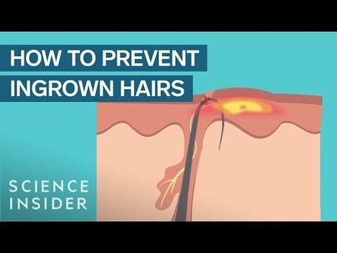 Discover the truth about " Do electric shavers cause ingrown hairs ? ". Learn how to avoid the problem and achieve a clean, smooth shave. Read on for expert tips and advice Treat Ingrown Hair, Lower Cholesterol Diet, Hair Science, Newborn Feeding, Prevent Ingrown Hairs, Shave My Head, Ingrown Hairs, Smooth Shave, Healthy Benefits