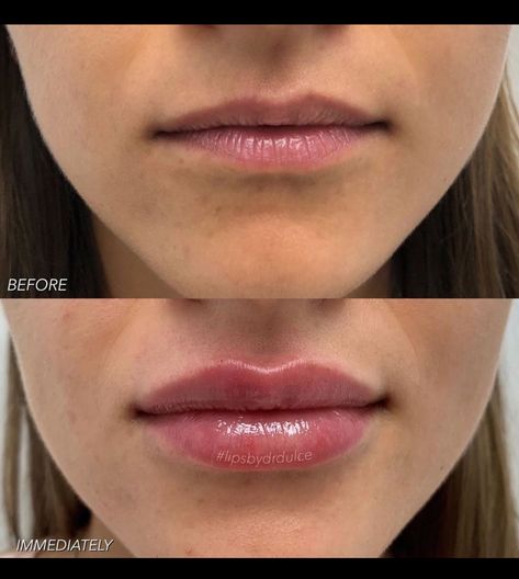 Lip Filler Half Syringe, Downward Turned Lips, 1ml Lip Filler Before And After, Bad Lip Filler, 0.5ml Lip Filler Before And After, Lip Filler After Care, Lip Injections Before And After, Lip Blushing Tattoo Before And After, Russian Lips Filler