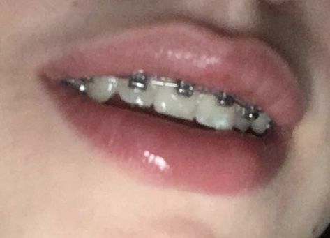 Braces Aethstetic, Brackets Aesthetic, Perfect Teeth Braces, Braces Aesthetic, Pink Braces, Braces Food, Braces Smile, Teeth Aesthetic, Cute Braces Colors