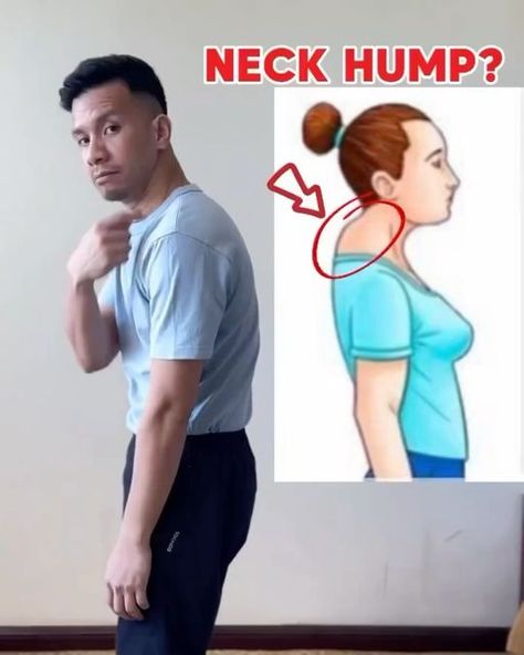 Healthy Herbs - Health Tips on Instagram: "Follow our new page @backpain.ins 
.
Save this post to fix your posture and get rid of pain ❤️

1) FIX NECK HUMP!! 🤩🤩🤩 

2) INSTANT SHOULDER PAIN RELIEF! 🤩🤩🤩 

3) INSTANT NECK PAIN RELIEF STRETCH! 🤩🤩🤩

Do you want get rid of back pain? 
👉Join our program the back pain miracle program link in bio! 

By @physicaltherapysession

#rotatorcuff #shoulderpain #shoulderworkout #fyp #omg #amazing
#neckhump #neckpain #posture" Fix Neck Hump, Exercise Posture, Neck Pain Relief Stretches, Neck Hump, Low Back Pain Relief, Fix Your Posture, Sciatica Relief, Shoulder Pain Relief, Back Pain Remedies