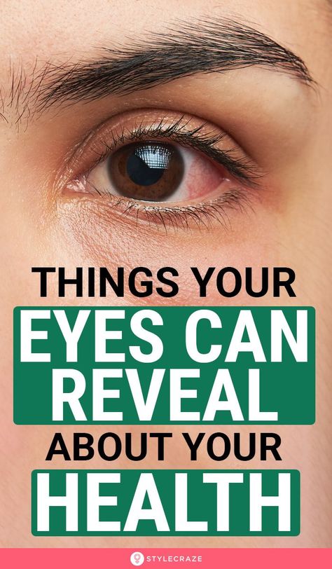 Eye Twitching, Health Signs, Tongue Health, Healthy Advice, Natural Cough Remedies, Daily Health Tips, Lose 40 Pounds, Health Check, Eye Health